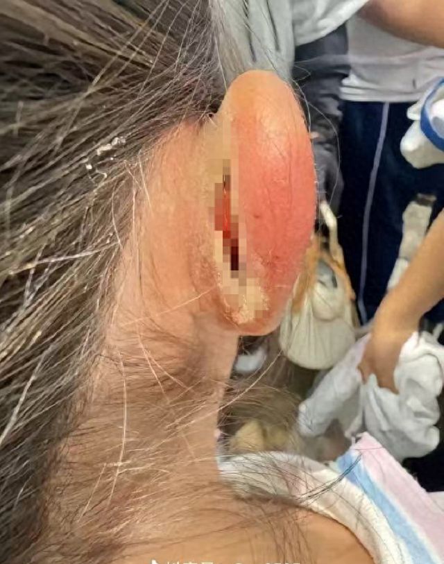 一年级女生课堂上“走神”，被老师揪伤耳朵缝5针；教育局：涉事者已被停课