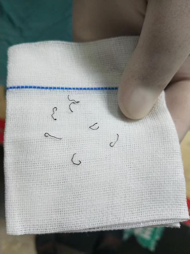 女子做痔疮手术留“隐患”：10年8次手术取出30多枚钛钉；法院判赔62万